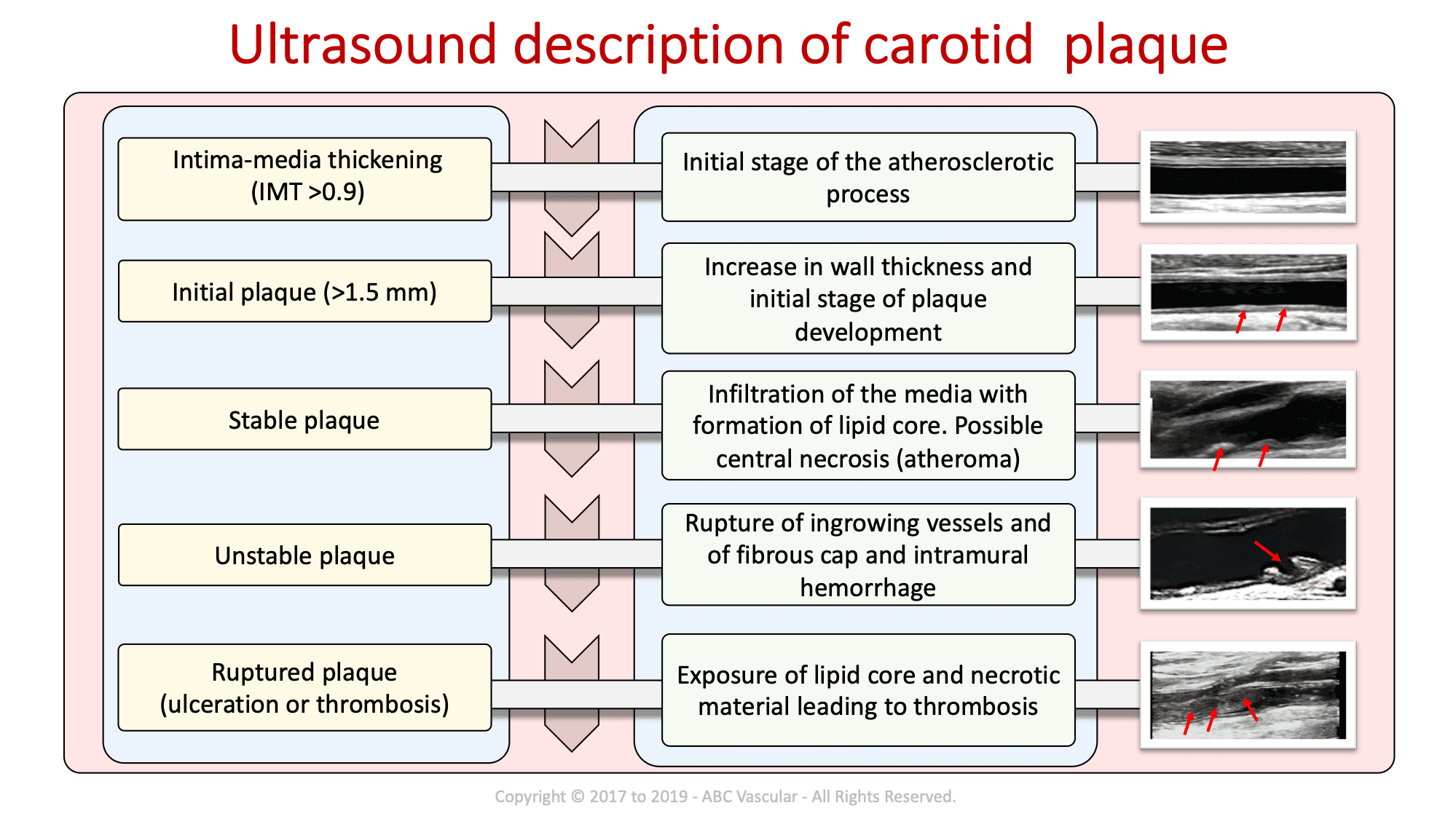Carotid Course Info | Abc Vascular With Carotid Ultrasound Report Template